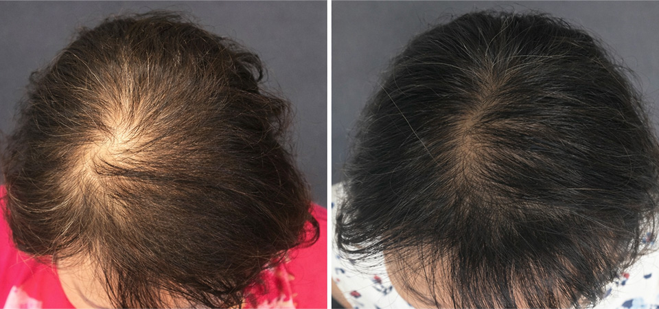 laser hair growth before after 1