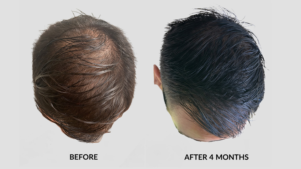 laser hair growth before after 2