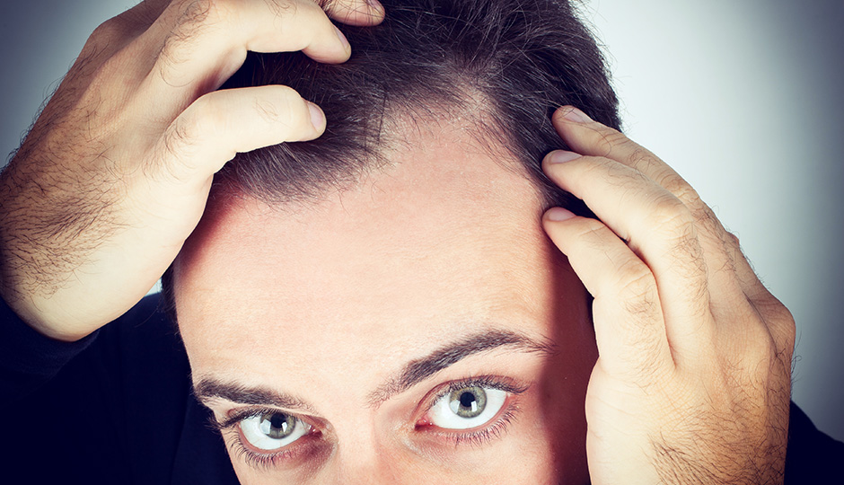 Reasons Why Your Hairline Might Be Receding