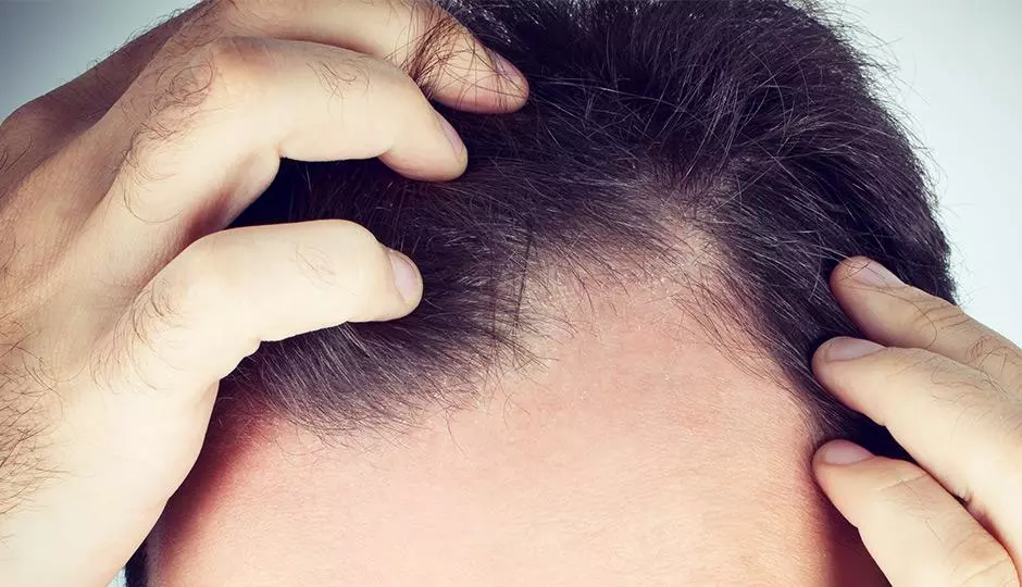 Hair Today, Gone Tomorrow: A Comedic Take on Hair Loss Journeys